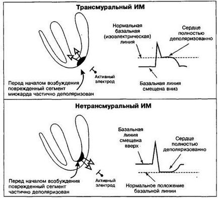 Зміни сегмента st і зубця т