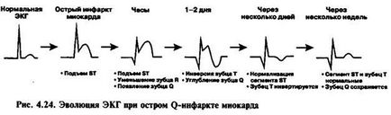 Зміни сегмента st і зубця т