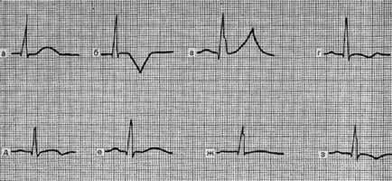 T hullám változások iszkémia alatt - elektrokardiogram szívinfarktus - Instruction