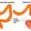 Cum să vindeciți diareea după administrarea de antibiotice