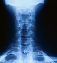 Клініка міжхребцевого хондроза і остеохондрозу хребта