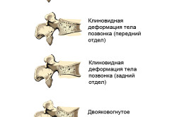 Compression csigolyatörés tünetek és a kezelés, rehabilitáció (videó)