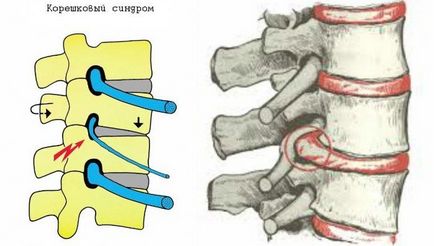 Sindromul lombar simptom radiologic, tratament, cum să scadă durerea severă