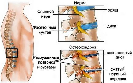 Sindromul lombar simptom radiologic, tratament, cum să scadă durerea severă