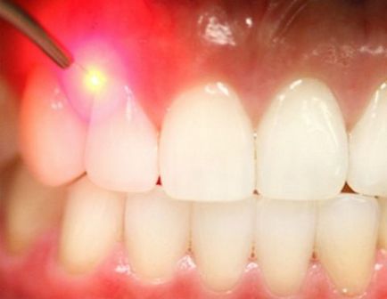 Tratamentul cu laser al gingiilor, cu incredere