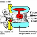 Tratamentul herniei intervertebrale fără intervenție chirurgicală în clinică - cemabet, clinic - cemabet