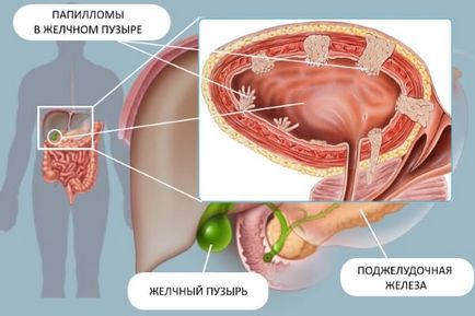 Tratamentul papilomului în vezica biliară