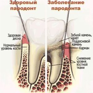 Tratamentul parodontitei cu ierburi