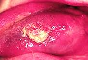 Tratamentul cancerului limbii - chirurgical