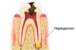 Krónikus periodontitis