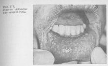 Лейкоплакія (ieucoplacia), терапевтична стоматологія