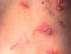 Tratamentul cu dermatita la nivelul pielii