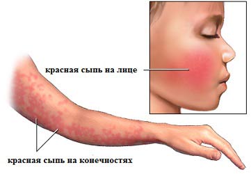 Lunca sau fitodermatita cum sa recunoasca si cum sa se trateze