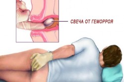 Unt de cacao cu metode de tratare a hemoroizilor