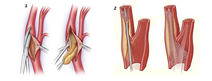 Chirurgie pe vasele gâtului, creierului și membrelor inferioare