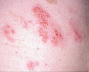 Herpes zoster fotografie, simptome, tratament, herpes zoster este contagios