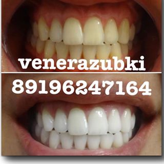 Відбілювання зубів казань - s photos in @venerazubki instagram account