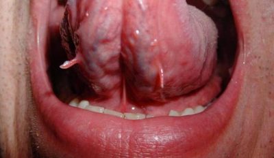 Papilloma în gură în cer și pe gingia la care medicul să se ocupe, cum să se trateze și să se elimine