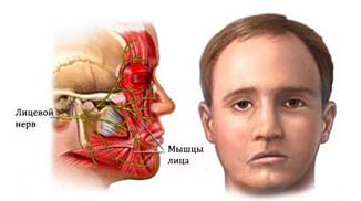 Parezia nervului facial la adulți și copii