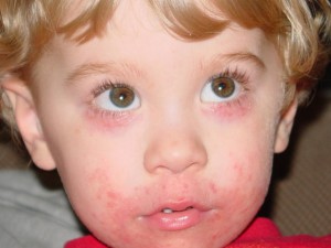 Dermatita dermatală la copii, secrete copilărești despre copii