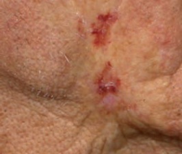 Efectele secundare ale tratamentului cancerului de piele bazală