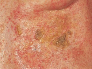 Побічні ефекти лікування базально-клітинного раку шкіри