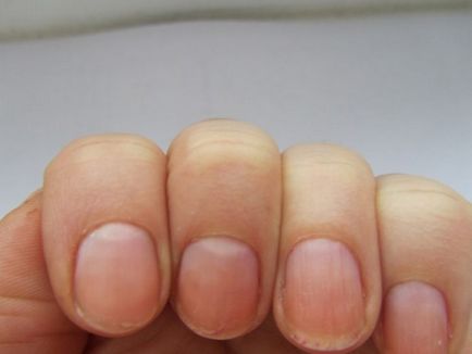 De ce unghiile devin cauze plate și tratament, recenzii