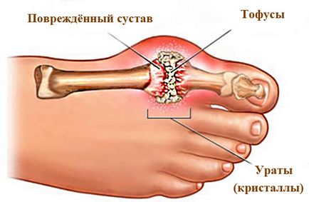 Подагра на пальці ноги - симптоми і лікування