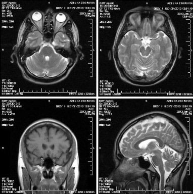 Підготовка до діагностики головного мозку методом МРТ