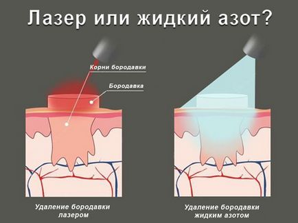 Подошвенная бородавка фото, лікування у домашніх умовах