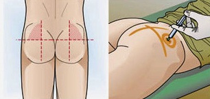 Procedura de punere în aplicare a injecției intramusculare