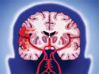 O alimentație corectă în caz de accident vascular cerebral (ischemică sau hemoragică)