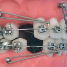 Застосування міні-імплантів в ортодонтії