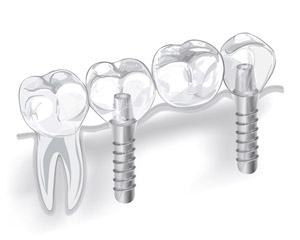 Protecția restaurării (restaurării) dinților, protezelor, coroanelor