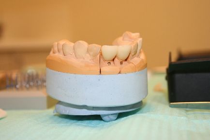 Протезування зубів в спб - підібрати тип протезування і записатися в клініку МедіЕстетік
