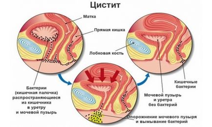 Psihosomatica si cauzele psihologice ale cistitei