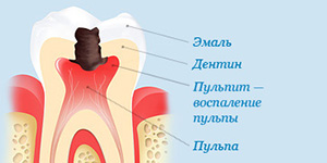 Пульпіт у дорослих і дітей симптоми і лікування, вартість