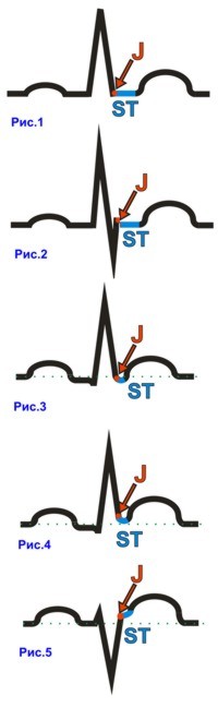 Розшифровка ЕКГ сегмент st - відповідає періоду серцевого циклу, коли обидва шлуночка охоплені