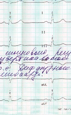 Megfejtése EKG fog t - rögzítve a kamrai repolarizáció