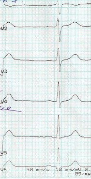 Megfejtése EKG fog t - rögzítve a kamrai repolarizáció