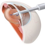 подмяна на пречупване обектив (lensektomiya) - най-добрите условия и цената, на клиника Москва Eye
