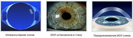 Refracție de înlocuire a lentilelor (lensectomie) - cele mai bune condiții și prețuri în clinica de ochi din Moscova