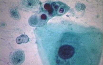 Profilaxia profilactică a amoeba, căile de infecție, tratamentul, diagnosticul