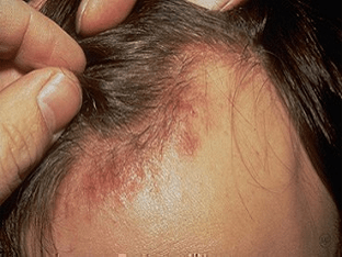 Себорея шкіри голови лікування себорейного дерматиту