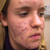 Себорейний дерматит на обличчі - причини, симптоми, лікування і профілактика