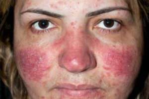 Себорейний дерматит на обличчі - причини, симптоми, лікування і профілактика