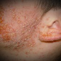 Dermatita seboreică pe față - cauze, simptome, tratament și prevenire