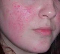 Seborrhoeás dermatitis az arcon - okai, tünetei, kezelése és megelőzése