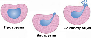 Herniile secvențiale, tratament