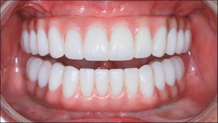 Знімні зубні протези плюси і мінуси конструкцій